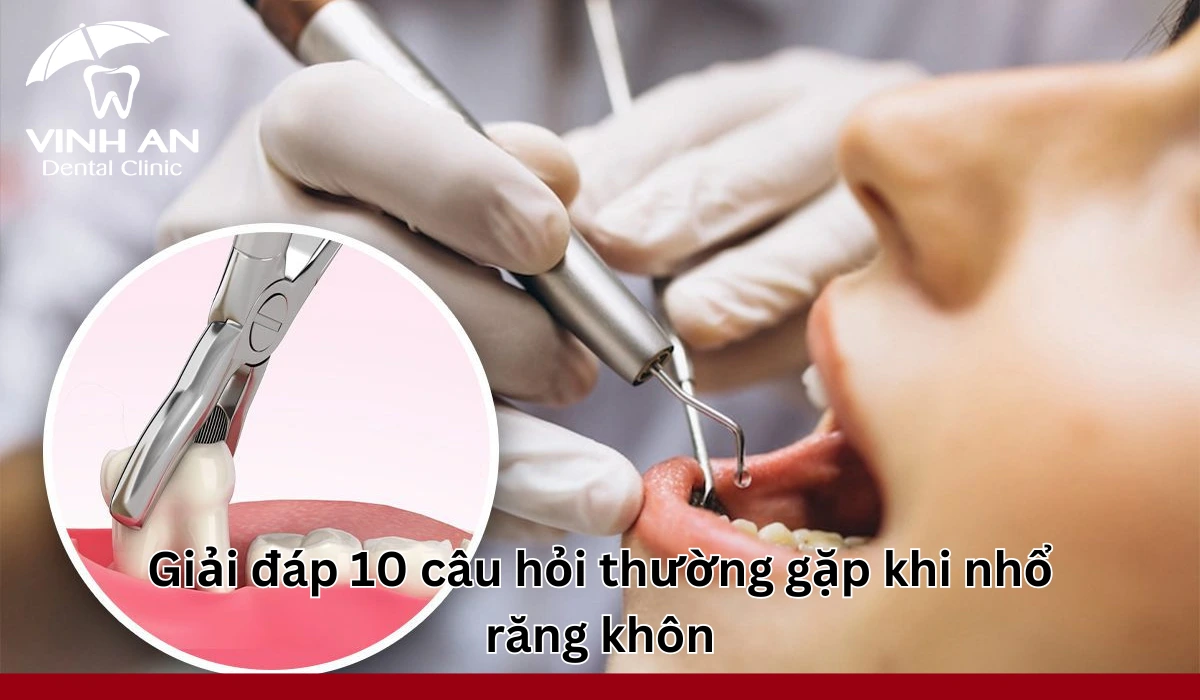 Cau-hoi-thuong-gap-nho-rang-khon