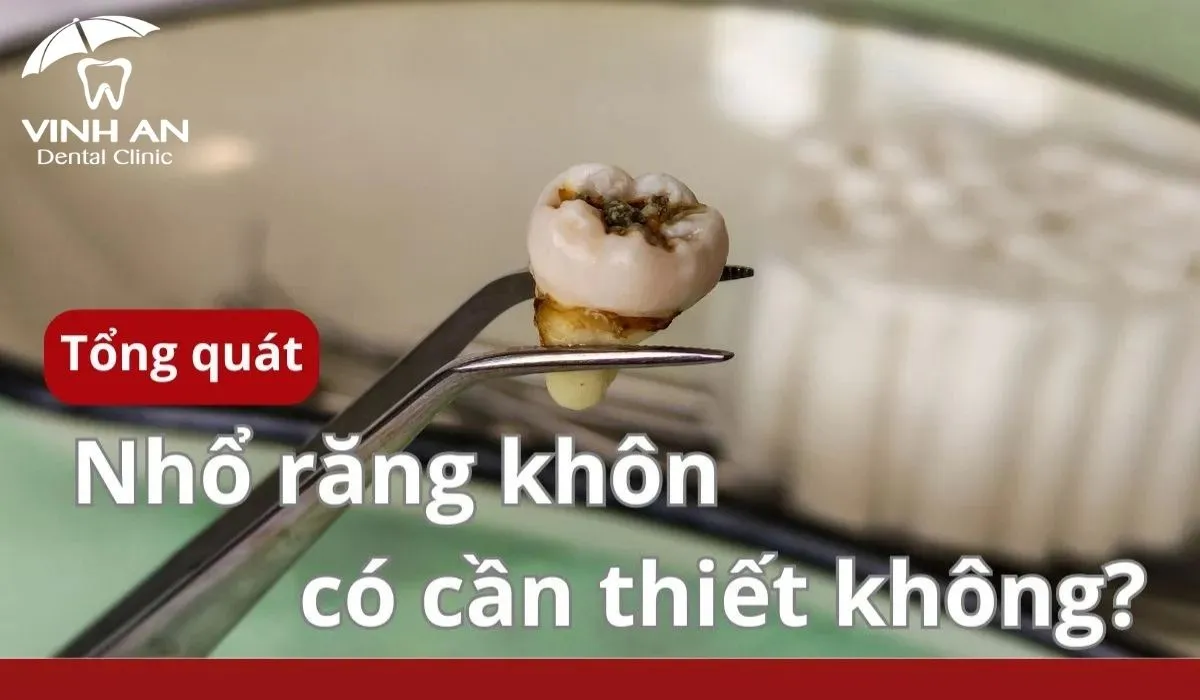 Nho-rang-khon-co-can-thiet-khong
