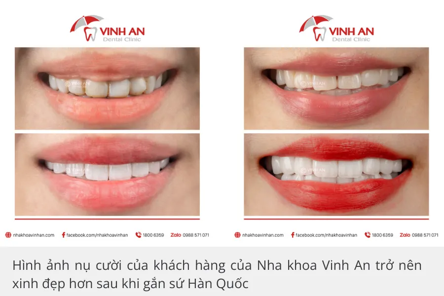 Nụ cười được cải thiện rõ rệt, răng trắng sáng, đều đẹp và mang lại vẻ tự tin cho khách hàng
