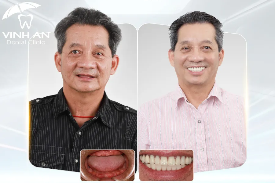 Hình ảnh khách hàng đã tin chọn Vinh An để trồng răng Implant và kết quả vượt mong đợi