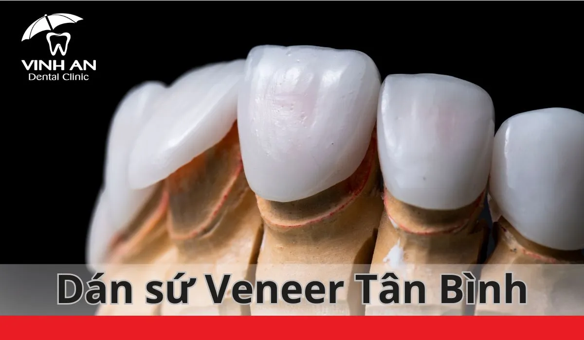 Dan-su-veneer-tan-binh (4)
