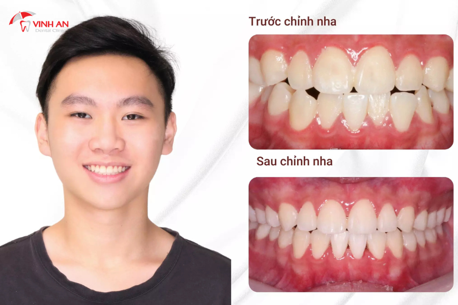 hình ảnh khách hàng niềng răng