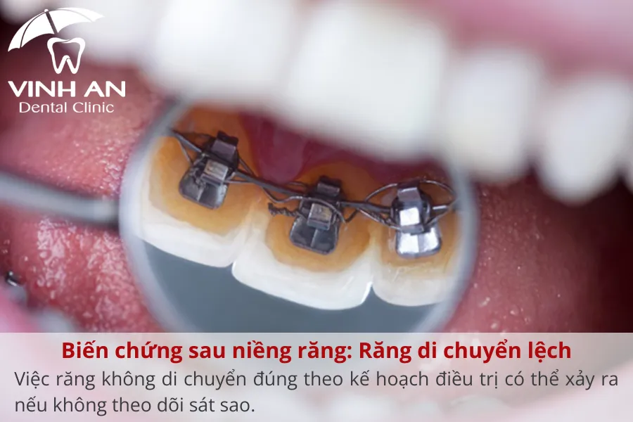 Bien-chung-nieng-rang-mat-luoi (7)