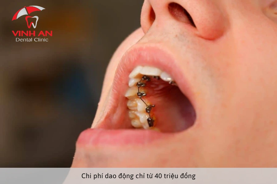 Chi phí niềng răng mặt lưỡi