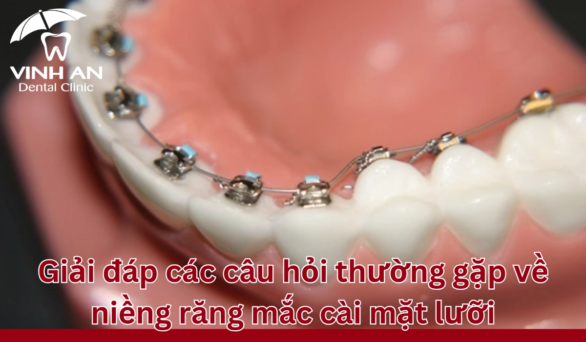 Cau-hoi-thuong-gap-nieng-rang-mat-luoi