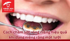 Cham-soc-rang-nieng-mat-luoi (4)