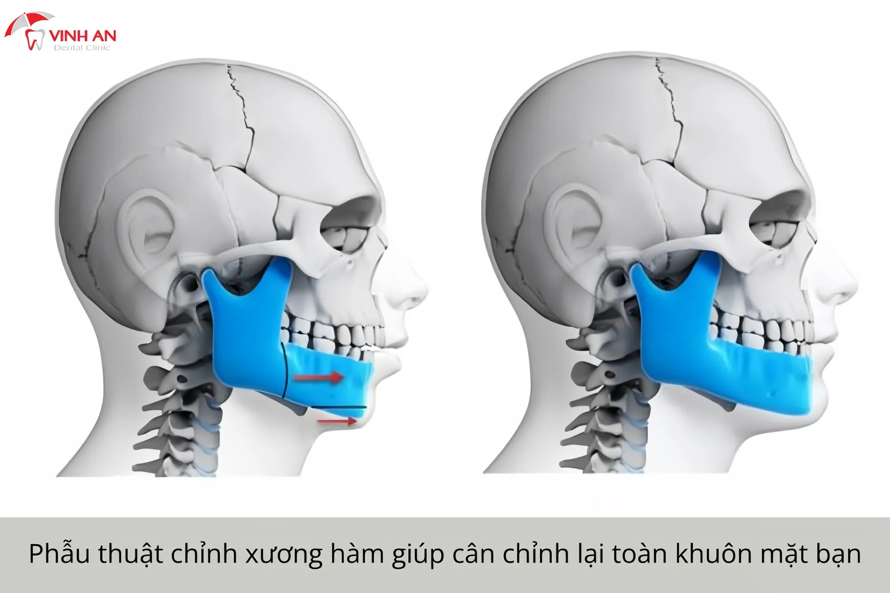 Chi-phi-dieu-tri-cuoi-ho-loi (2)