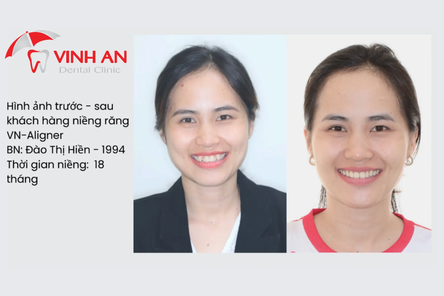 Chi-phi-nieng-rang-trong-suot-4
