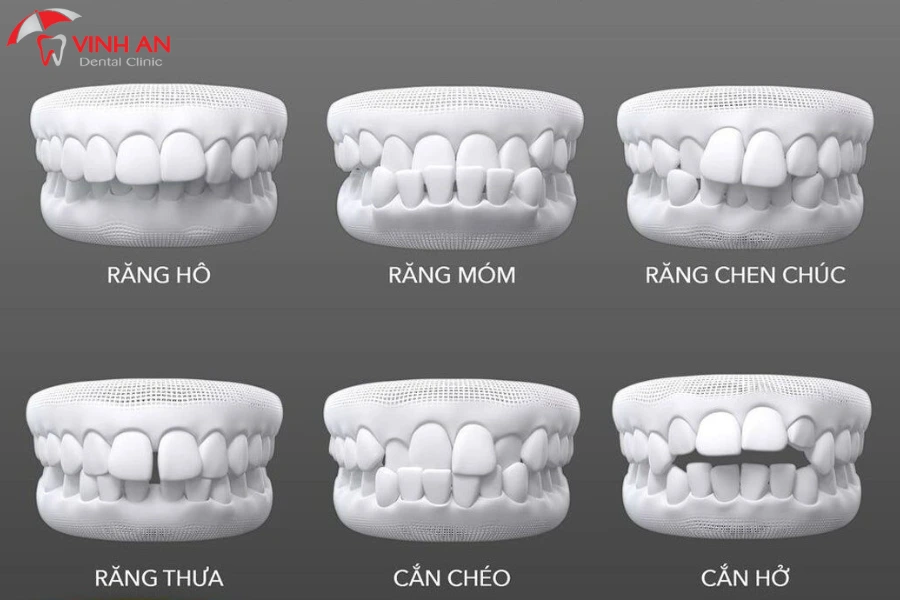 Doi-tuong-nieng-rang-mat-luoi (1)
