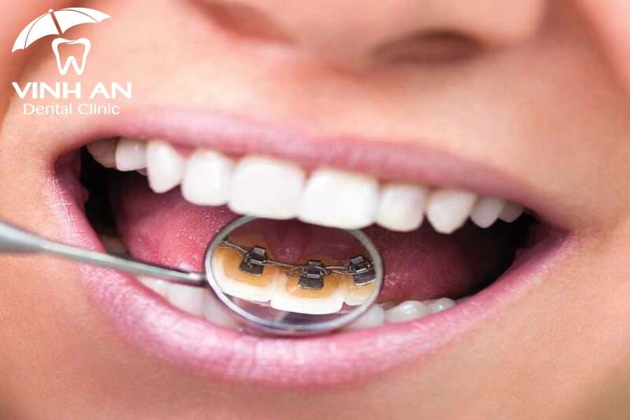 Doi-tuong-nieng-rang-mat-luoi