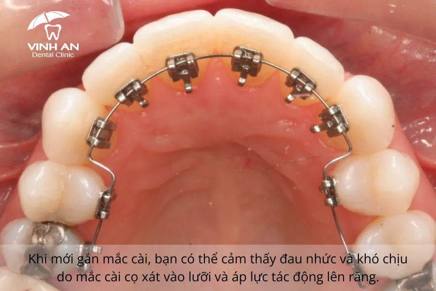Nieng-rang-mac-cai-mat-luoi-co-dau-khong (2)