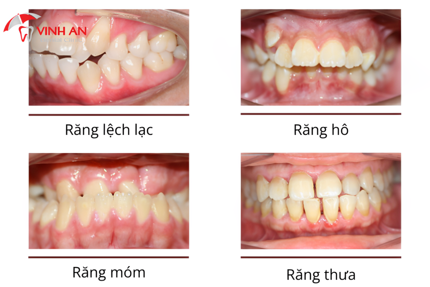 Quy-trinh-nieng-rang-trong-suot (1)