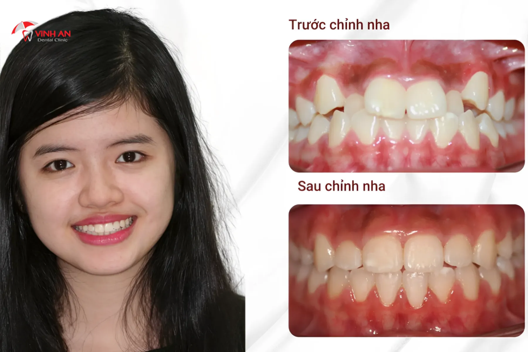 Quy-trinh-nieng-rang-trong-suot (5)