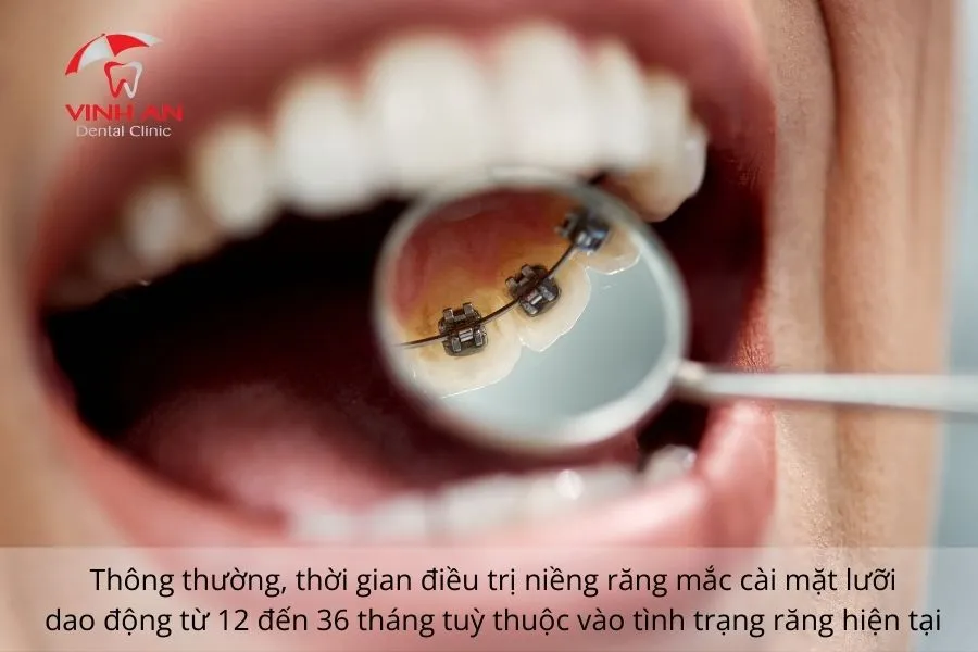 Thoi-gian-nieng-rang-mat-luoi (3)
