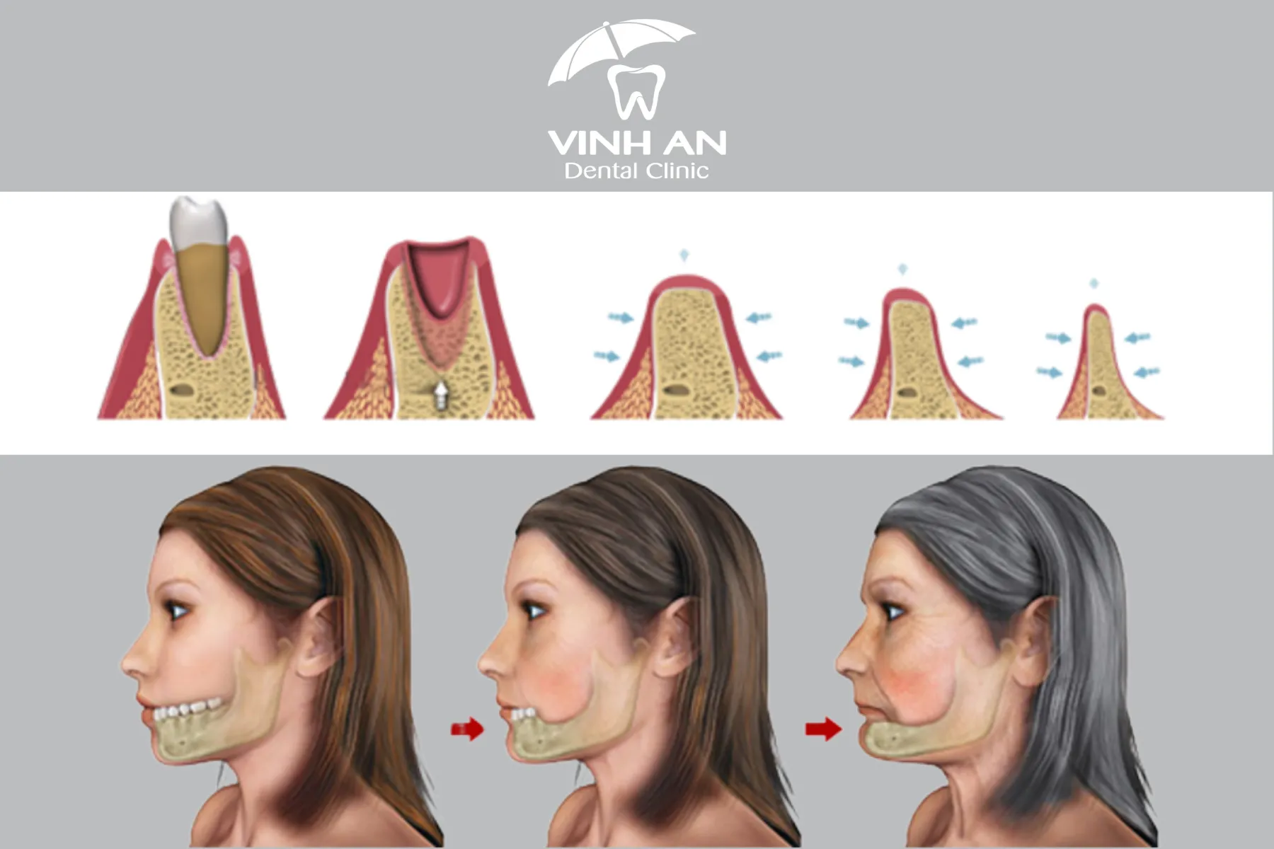 Tai-sao-phai-cay-ghep-implant-1