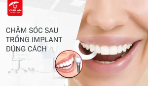 cham-soc-sau-trong-Implant