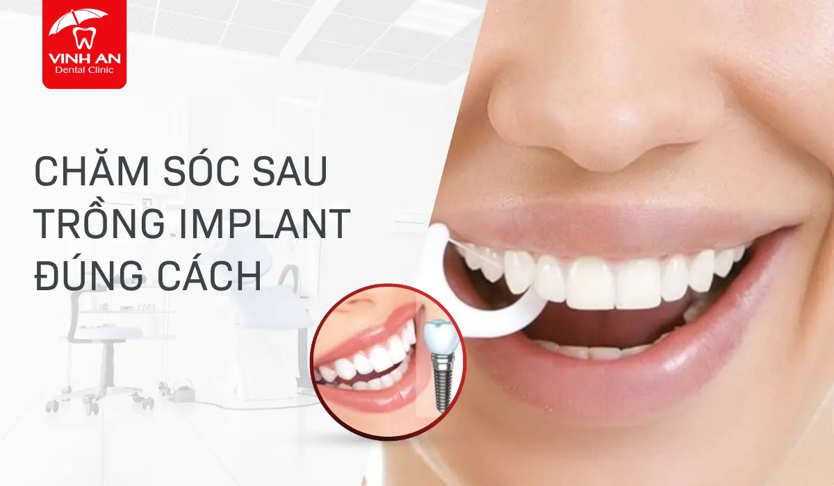 cham-soc-sau-trong-Implant