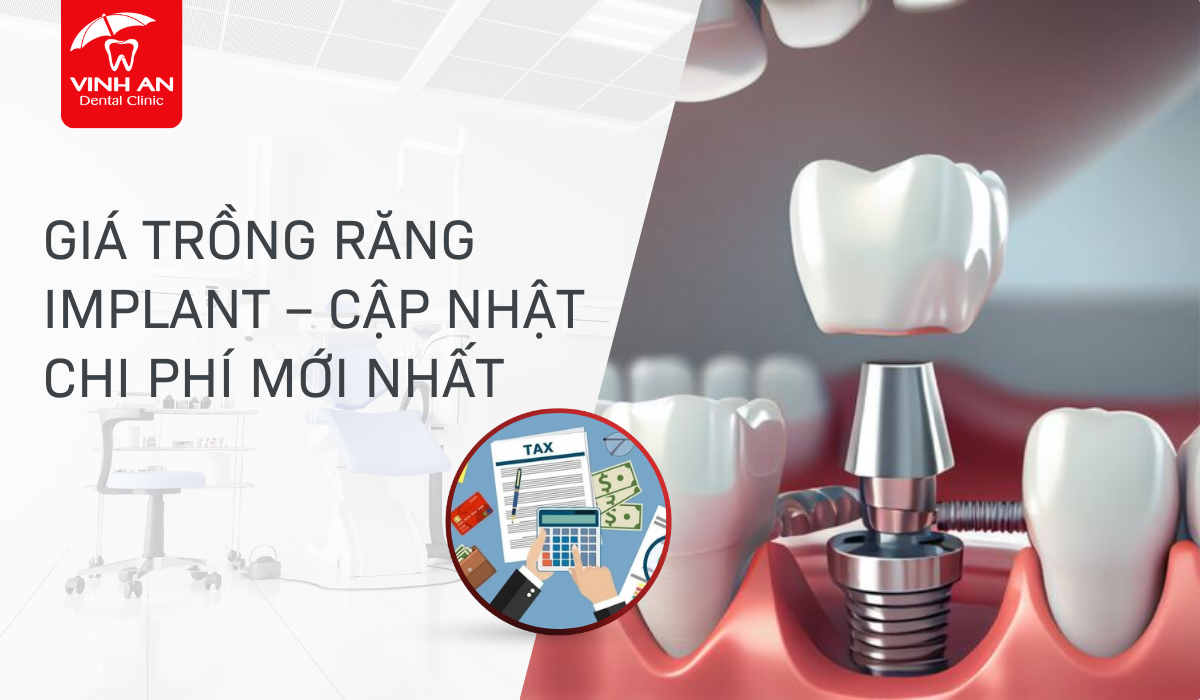gia-trong-răng-Implant
