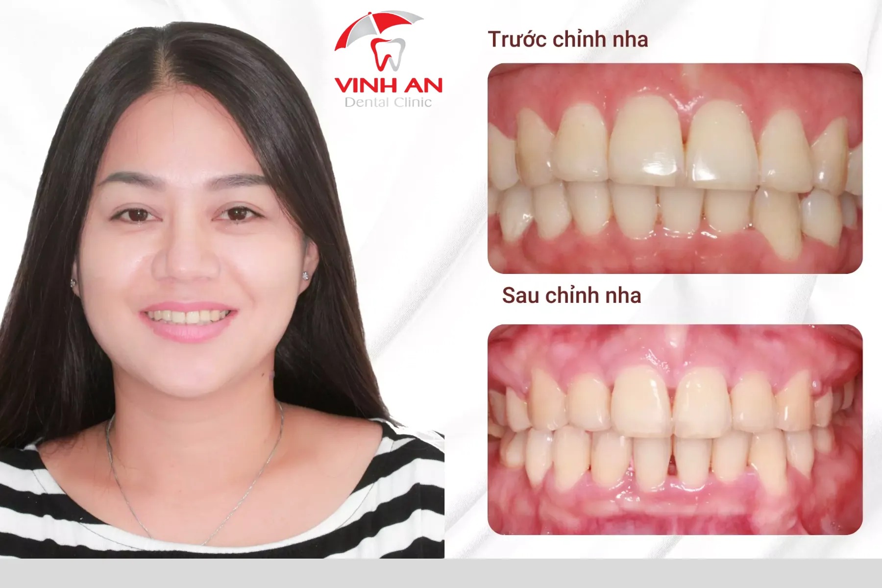 Khách hàng chỉnh nha tại nha khoa Vinh An