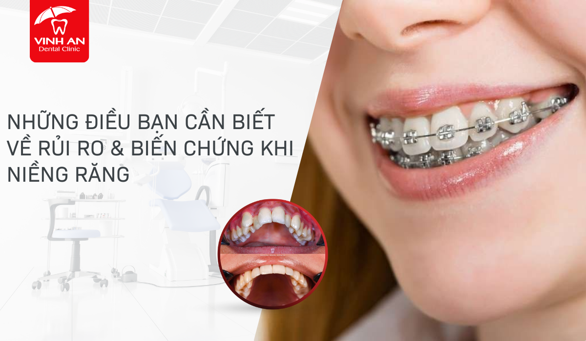bien-chung-khi-nieng-rang