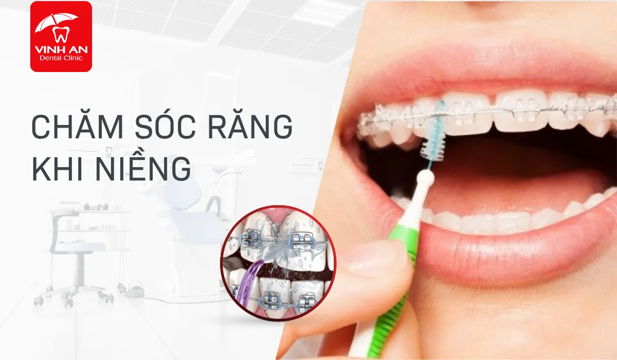 Thumbnail-cham-soc-rang-khi-nieng