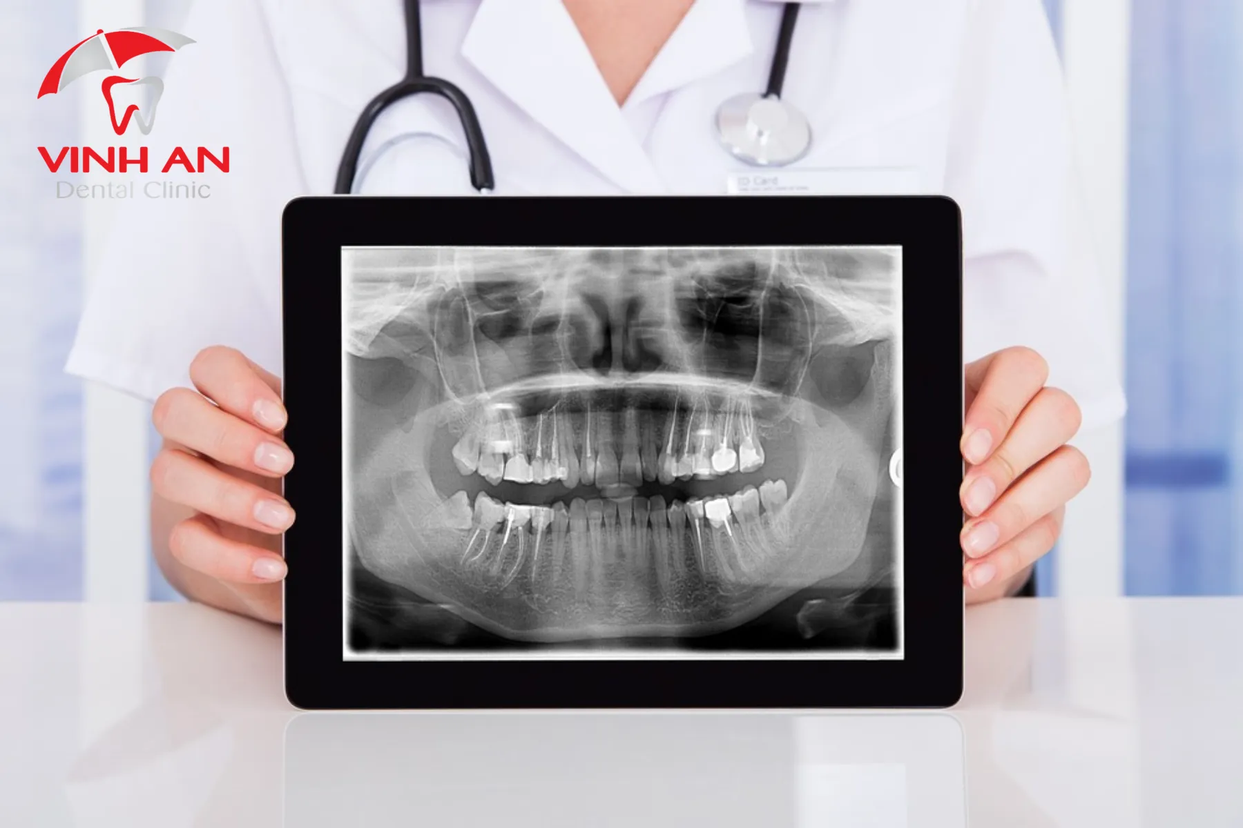 Các loại niềng răng phổ biến