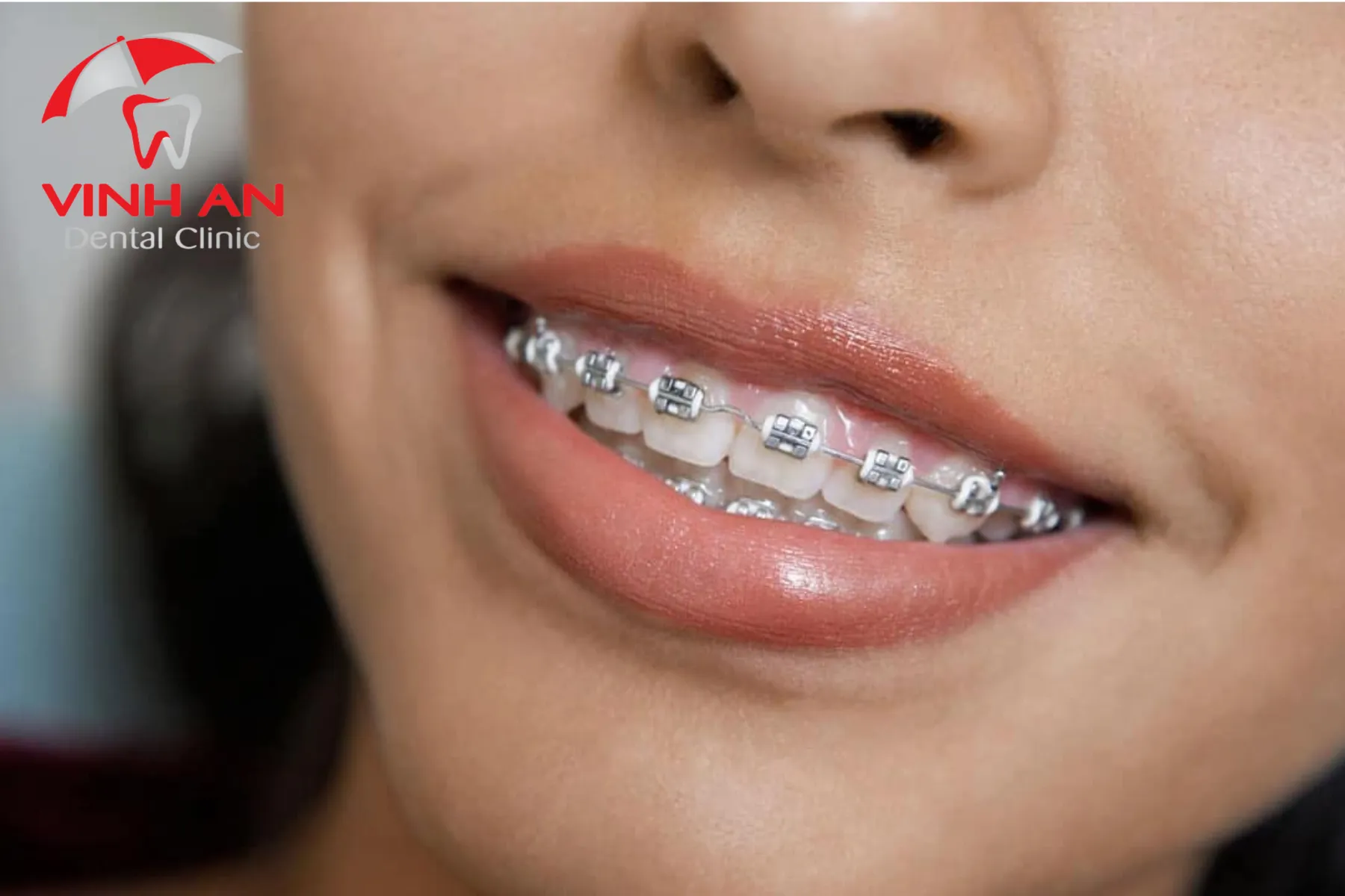 Mắc cài kim loại truyền thống vẫn là phương án tiết kiệm và hiệu quả nhất, được nhiều người lựa chọn