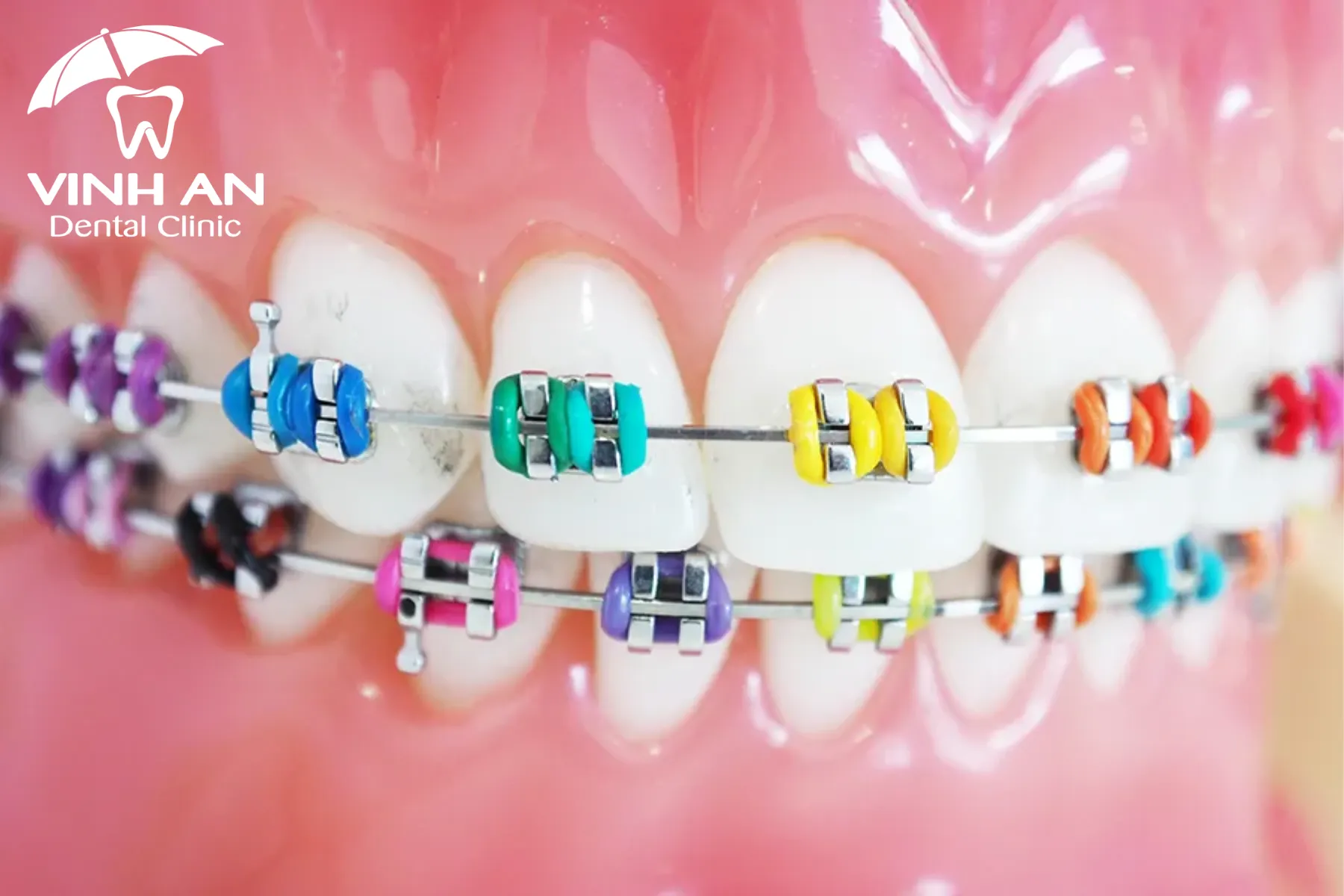 Bí kíp chọn các loại niềng răng phù hợp và đúng chuẩn theo tình trạng của bạn