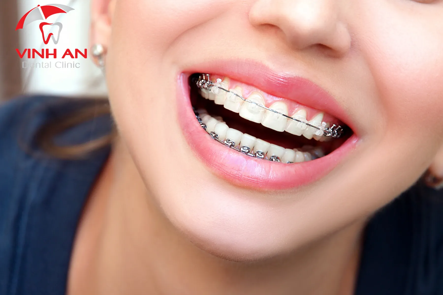 Bí kíp lựa chọn các phương pháp niềng răng phổ biến