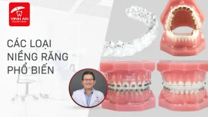 Các loại niềng răng phổ biến hiện nay