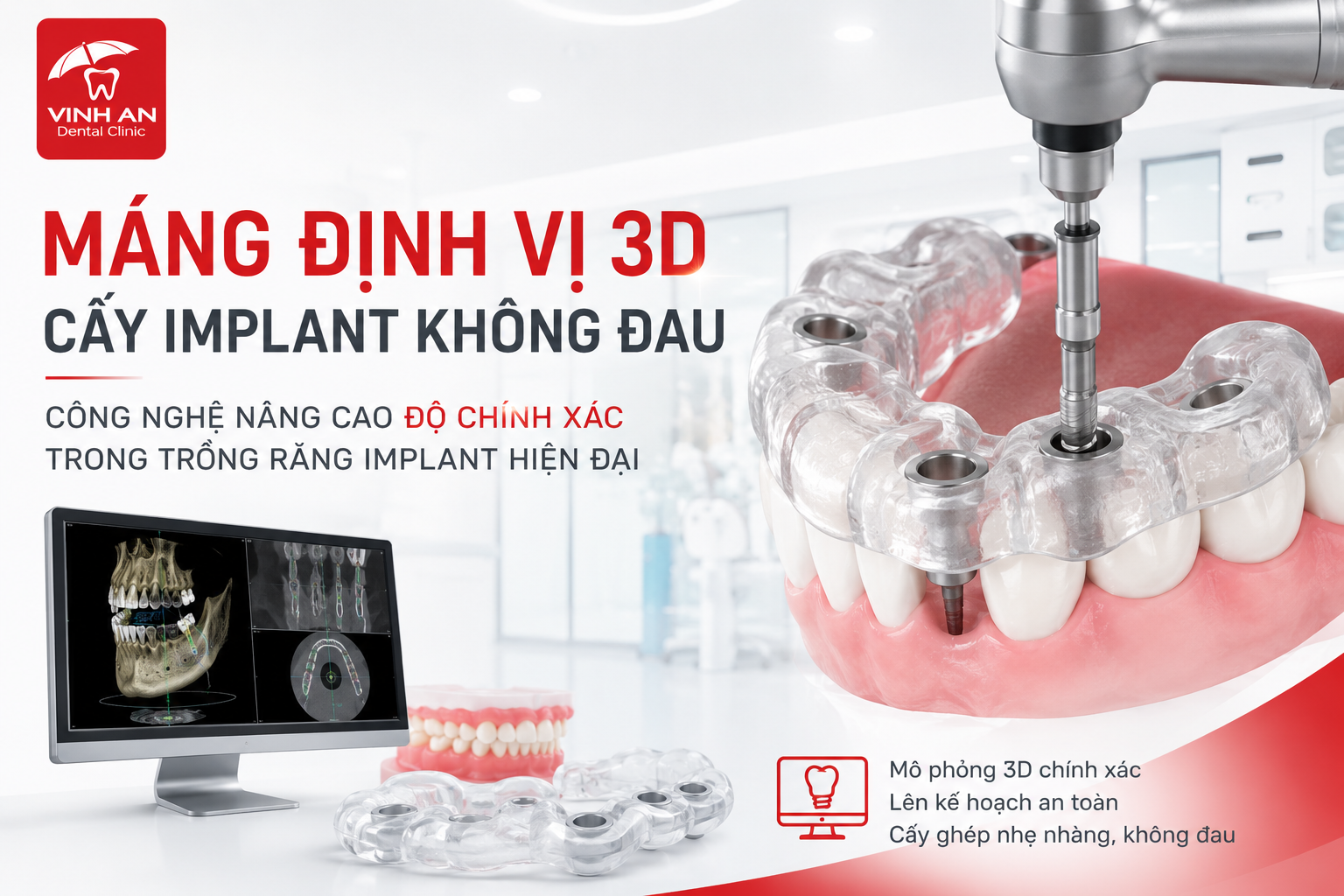 Máng Định Vị 3D Cấy Implant Không Đau