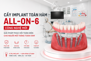 Cấy Implant Toàn Hàm All-on-6 Công Nghệ Mới: Giải Pháp Phục Hồi Toàn Diện Cho Người Mất Răng Toàn Hàm