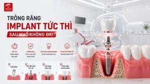 Trồng Răng Implant Tức Thì Sau Nhổ Không Đau