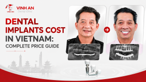 Dental Implants Cost in Vietnam: Complete Price Guide 