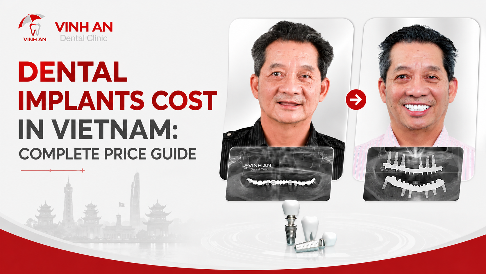 Dental Implants Cost in Vietnam: Complete Price Guide 